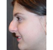 Cosmetic Nose Surgery (Rhinoplasty)